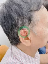 Vì sao nên đeo máy trợ thính 2 tai